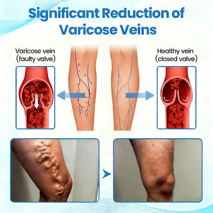 🇺🇸🎁GFOUK® VascuCare Vein Healing Spray(Designed for Varicose veins, Spider veins, Deep vein Thrombosis, Chronic venous insufficiency, Venous ulcers, Thrombophlebitis and other venous issues)