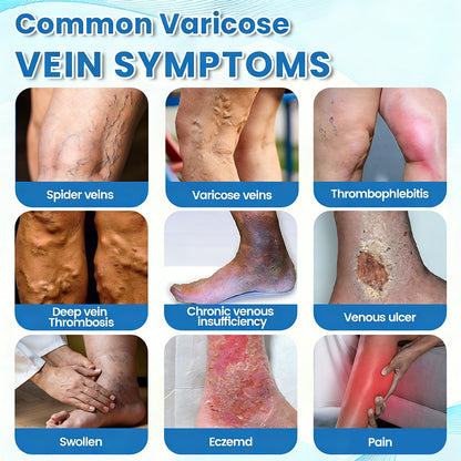 🇺🇸🎁GFOUK® VascuCare Vein Healing Spray(Designed for Varicose veins, Spider veins, Deep vein Thrombosis, Chronic venous insufficiency, Venous ulcers, Thrombophlebitis and other venous issues)