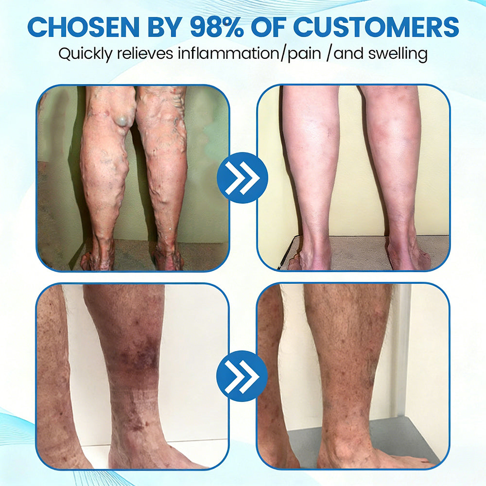 🇺🇸🎁GFOUK® VascuCare Vein Healing Spray(Designed for Varicose veins, Spider veins, Deep vein Thrombosis, Chronic venous insufficiency, Venous ulcers, Thrombophlebitis and other venous issues)