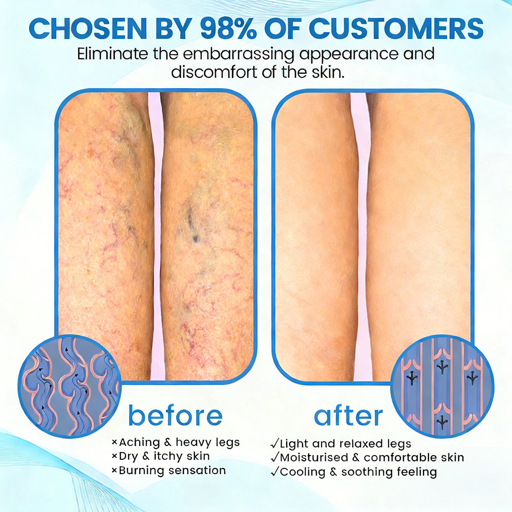 🇺🇸🎁GFOUK® VascuCare Vein Healing Spray(Designed for Varicose veins, Spider veins, Deep vein Thrombosis, Chronic venous insufficiency, Venous ulcers, Thrombophlebitis and other venous issues)