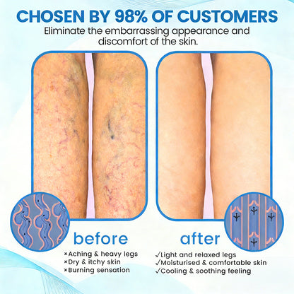 🇺🇸🎁GFOUK® VascuCare Vein Healing Spray(Designed for Varicose veins, Spider veins, Deep vein Thrombosis, Chronic venous insufficiency, Venous ulcers, Thrombophlebitis and other venous issues)