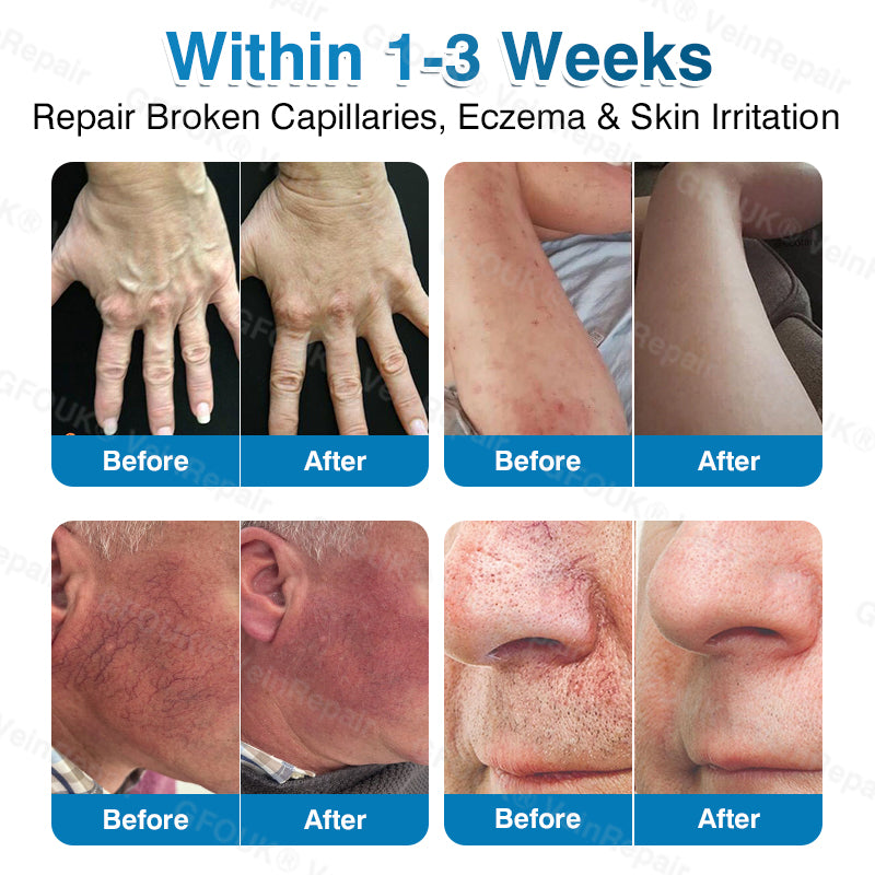 🇺🇸👨‍⚕️👨‍⚕️✅GFOUK® VeinRepair Microneedle Patch Roll⚡Instant Relief, Long-Term Results