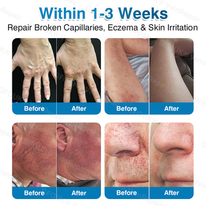 🇺🇸👨‍⚕️👨‍⚕️✅GFOUK® VeinRepair Microneedle Patch Roll⚡Instant Relief, Long-Term Results