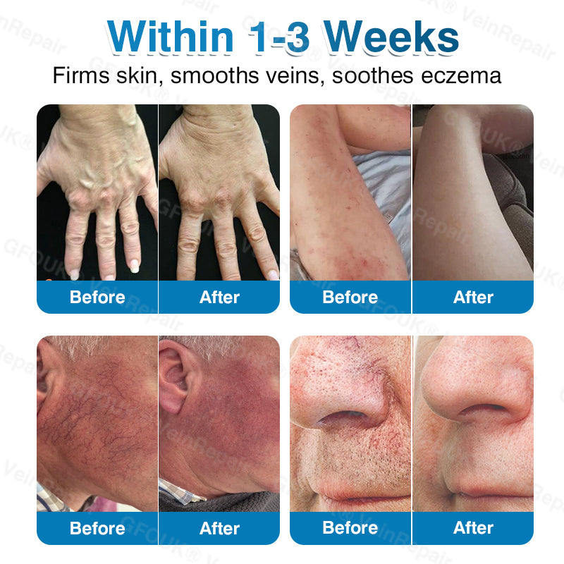 🇺🇸🎁GFOUK® VeinRepair Microneedle Patch Roll⚡Instant Relief, Long-Term Results