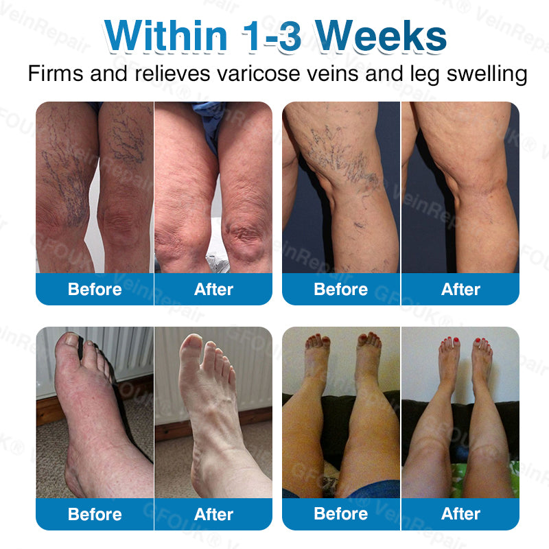 🇺🇸🎁GFOUK® VeinRepair Microneedle Patch Roll⚡Instant Relief, Long-Term Results