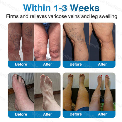 🇺🇸🎁GFOUK® VeinRepair Microneedle Patch Roll⚡Instant Relief, Long-Term Results