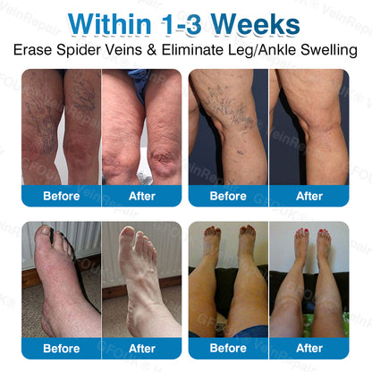 🇺🇸👨‍⚕️👨‍⚕️✅GFOUK® VeinRepair Microneedle Patch Roll⚡Instant Relief, Long-Term Results