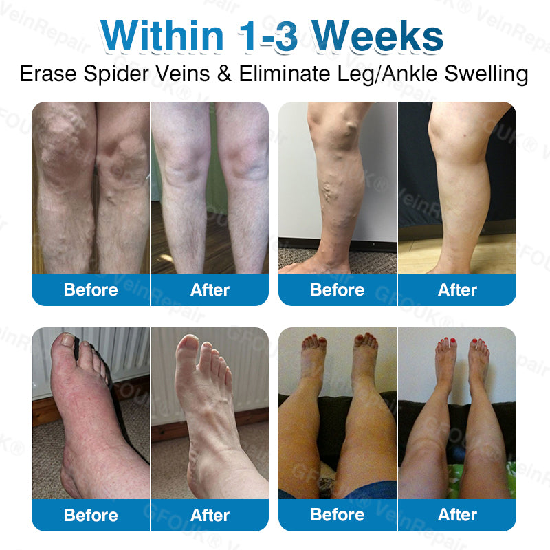 🇺🇸✅GFOUK® VeinRepair Microneedle Patch Roll⚡Instant Relief, Long-Term Results