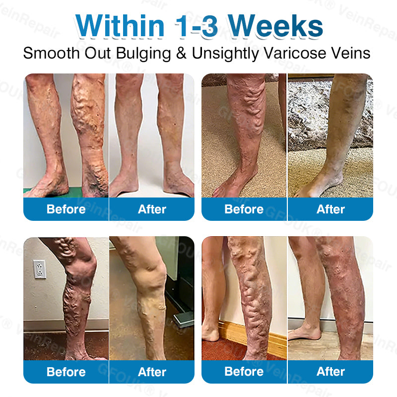 🇺🇸👨‍⚕️👨‍⚕️✅GFOUK® VeinRepair Microneedle Patch Roll⚡Instant Relief, Long-Term Results