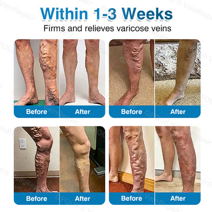 🇺🇸🎁GFOUK® VeinRepair Microneedle Patch Roll⚡Instant Relief, Long-Term Results