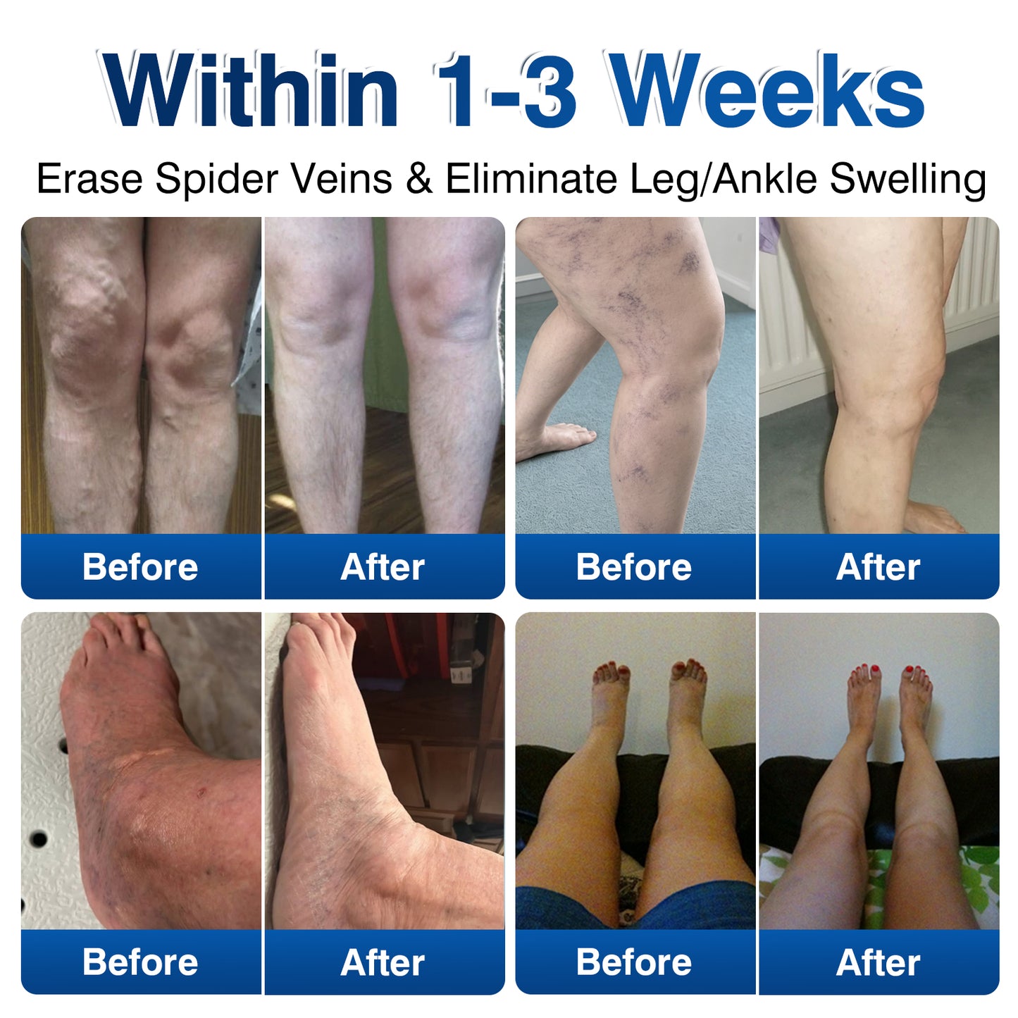 🇺🇸🎁GFOUK® VeinRenew Microneedle Balm