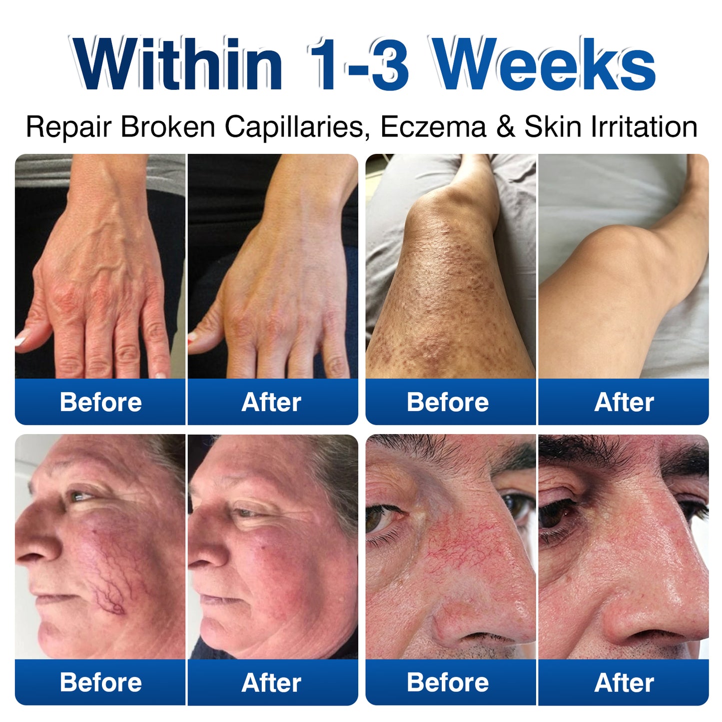 🇺🇸🎁GFOUK® VeinRenew Microneedle Balm