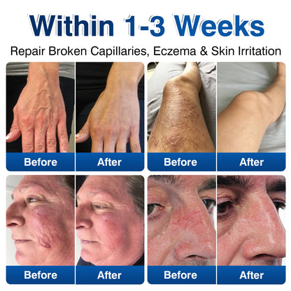 🇺🇸🎁GFOUK® VeinRenew Microneedle Balm