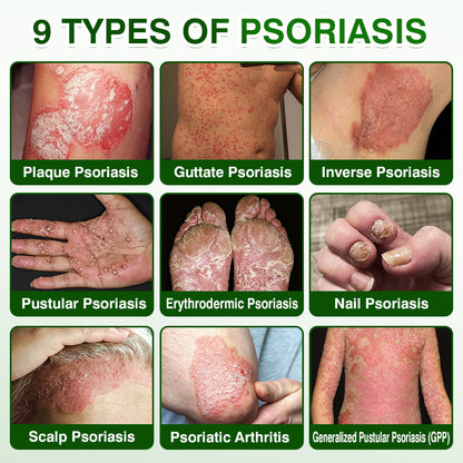 🇺🇸🏅🛡️✅DOCTIA® SkinRecovery Reishi Psoriasis Repair Spray