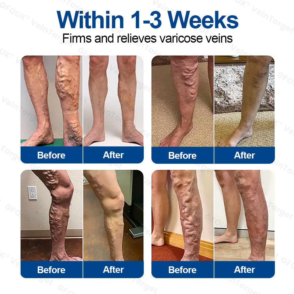 🇺🇸👨⚕️✅✅GFOUK® VeinTarget Microneedle Patch⚡Instant Relief, Long-Term Results