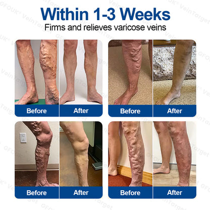🇺🇸👨‍⚕️✅GFOUK® VeinTarget Microneedle Patch⚡Instant Relief, Long-Term Results