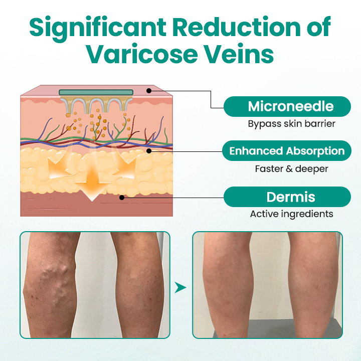 FDA-Approved👨‍⚕️✅🌿GFOUK® LegRenew Varicose Veins Patch(⚡Instant Relief, Long-Term Results)
