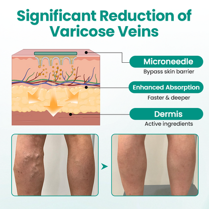 FDA-Approved👨‍⚕️✅🌿GFOUK® LegRenew Varicose Veins Patch(⚡Instant Relief, Long-Term Results)
