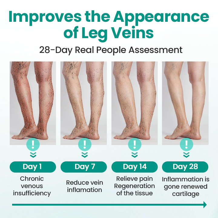 FDA-Approved👨‍⚕️✅🌿GFOUK® LegRenew Varicose Veins Patch(⚡Instant Relief, Long-Term Results)