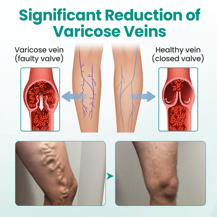 FDA-Approved👨‍⚕️✅🌿GFOUK® LegRenew Varicose Veins Patch(⚡Instant Relief, Long-Term Results)