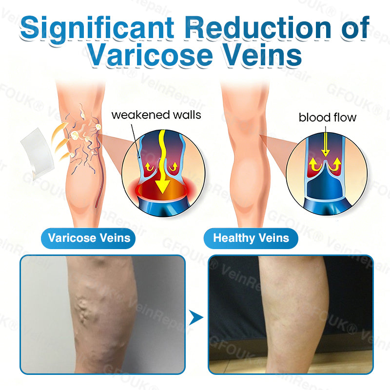 🇺🇸✅GFOUK® VeinRepair Microneedle Patch Roll⚡Instant Relief, Long-Term Results